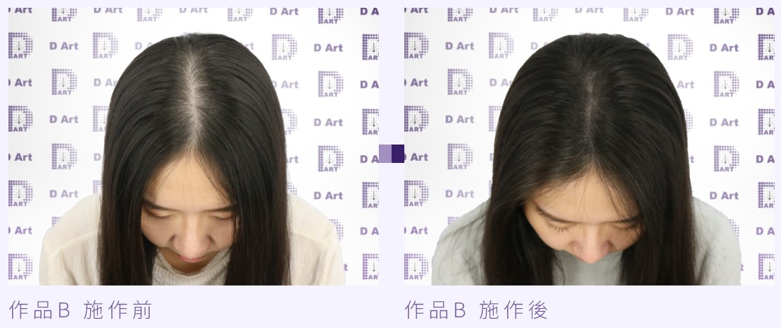 無針擬真繡髮案例B